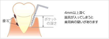 歯周ポケット　プラーク　歯石