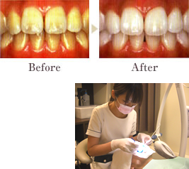 ホワイトニング施術前・施術後